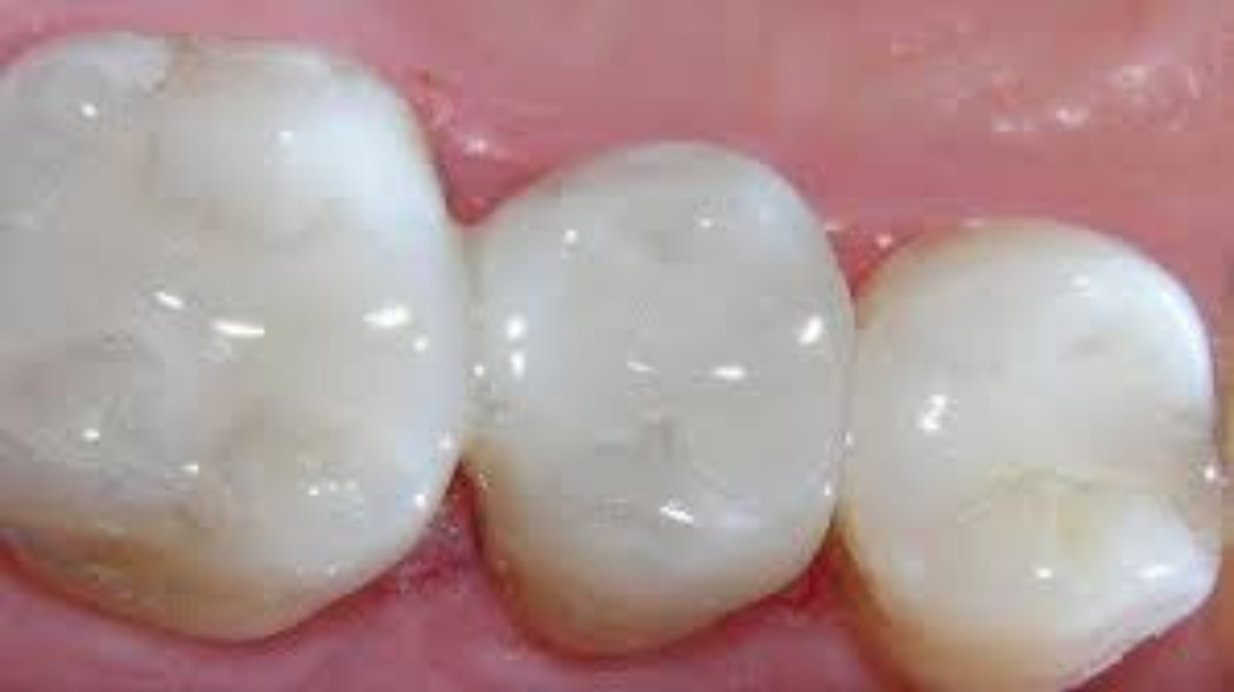 best tooth colord fillings and cements in guntur