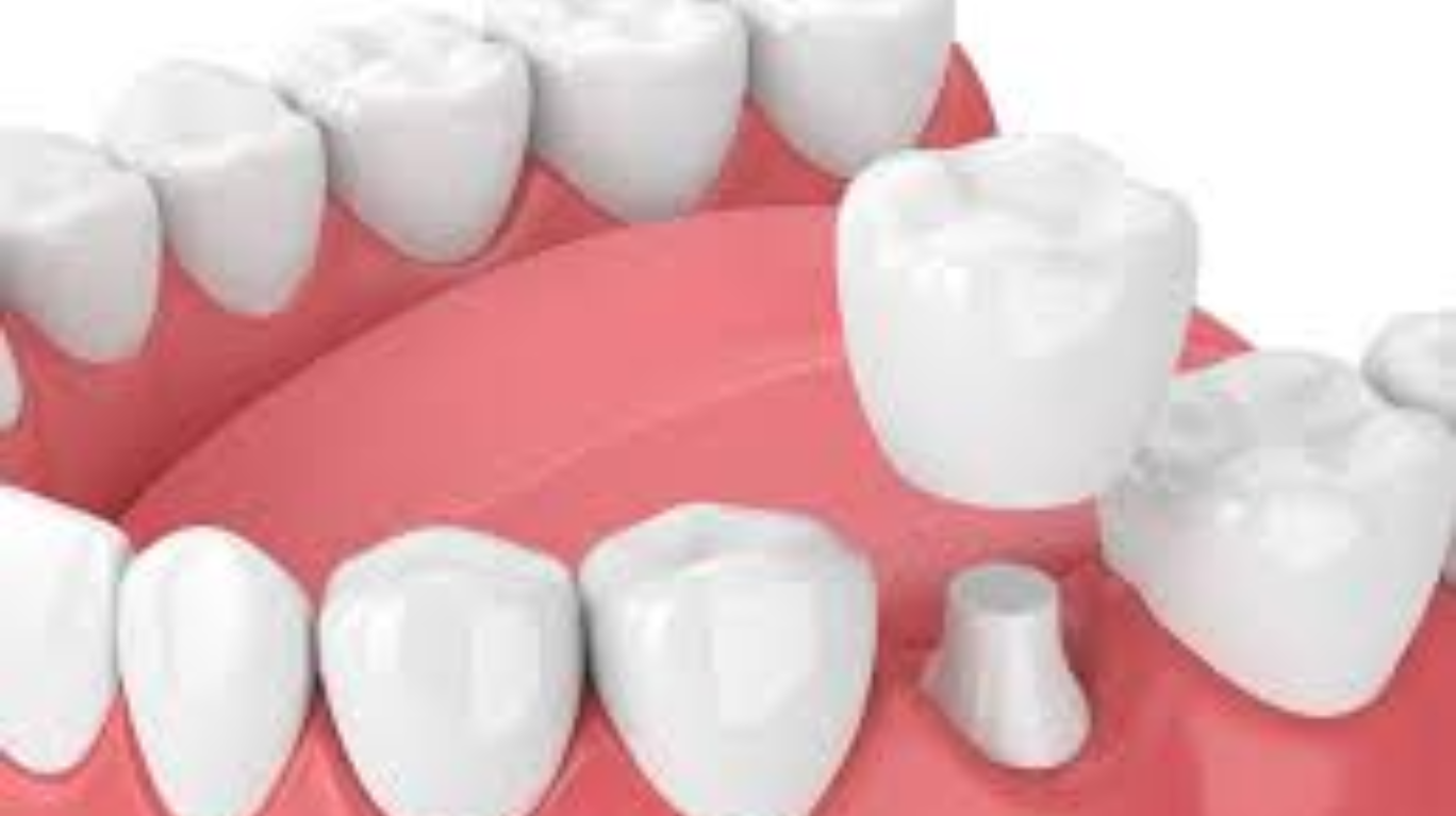 best zirconia crowns in guntur