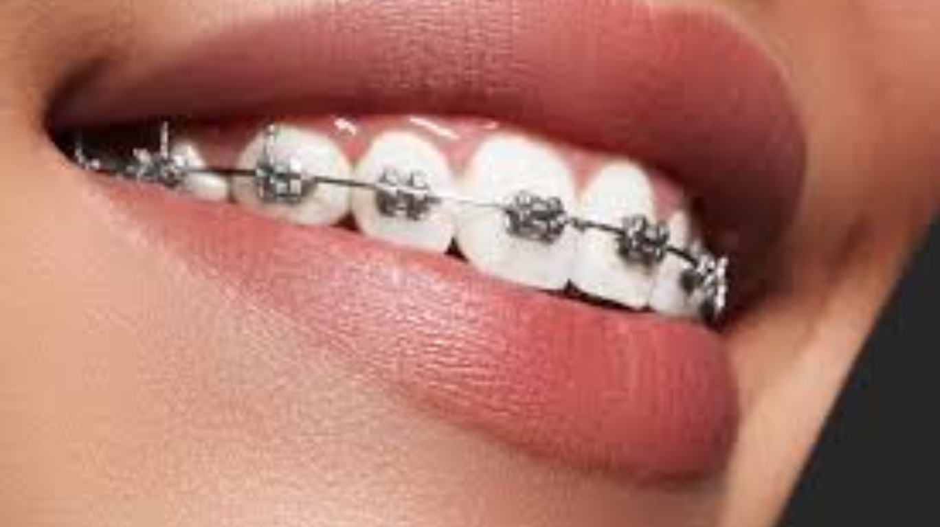 best braces & clips &
                                    aligners (orthodontics) in guntur