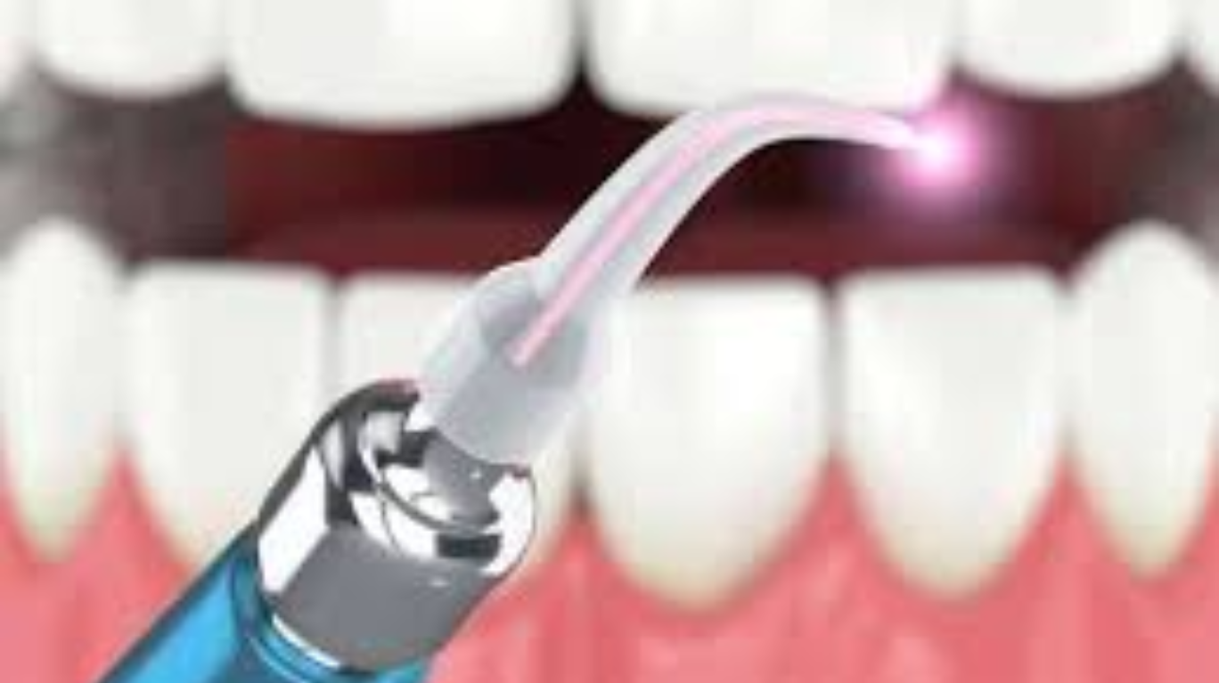 best teeth whitening in guntur